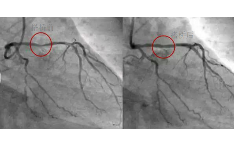 深圳市模具廠對心臟支架的關注，國產化的道路有多長？